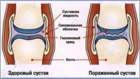 Превью картинка статьи Лечится ли артроз — Суставы