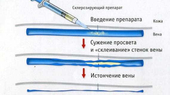 Превью картинка статьи Склеротерапия вен нижних конечностей: что это такое, чем опасна, противопоказания, осложнения и что делать после?