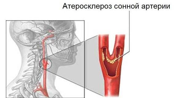 Превью картинка статьи Атеросклеротические бляшки в сонной артерии лечение — Сердце