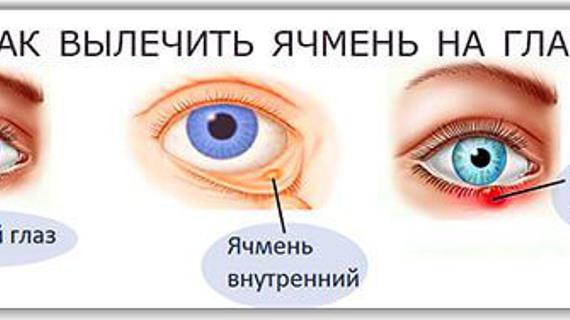 Превью картинка статьи Ячмень на глазу: причины появления, симптомы и лечение