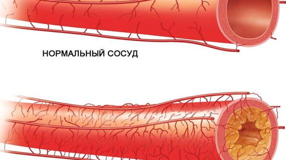 Превью картинка статьи Атеросклеротическое поражение сосудов — Про сосуды