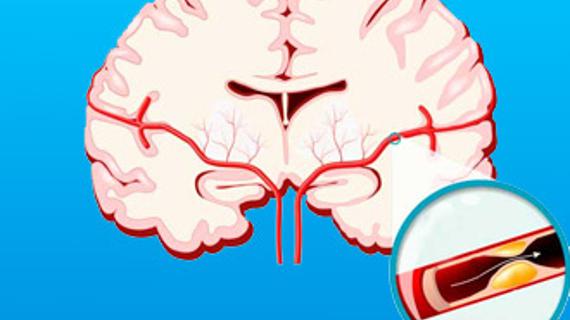 Превью картинка статьи Препараты для лечения атеросклероза: статины, фибраты и другие таблетки