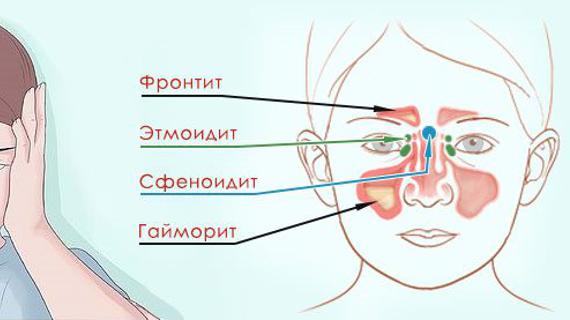 Синусит у детей. Синусит фронтит этмоидит. Симптомы риносинусита у детей. Пазухи носа анатомия гайморит.