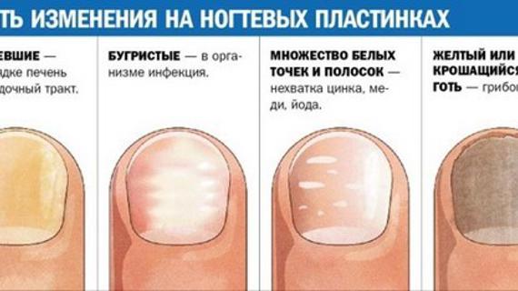 О чем говорят изменения ногтей. О чем говорят изменения ногтей