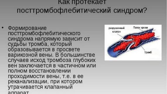 Превью картинка статьи Флеботромбоз глубоких вен нижних конечностей: симптомы, код по мкб 10, в чем разница с тромбофлебитом, лечение и диета