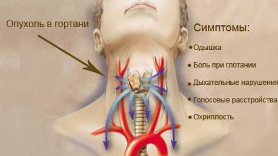 Превью картинка статьи Мята вызывает рак гортани