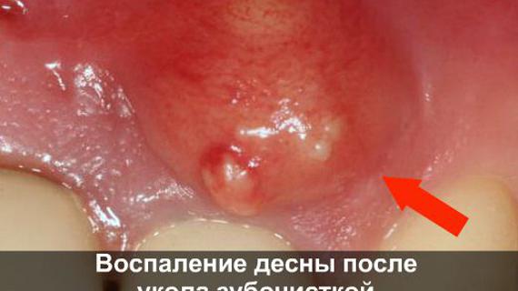 Превью картинка статьи Уколола десну костью от рыбы чем лечить