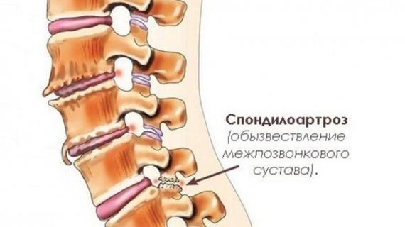 Превью картинка статьи Спондилоартроз пояснично-крестцового отдела позвоночника: что такое и лечение уколами
