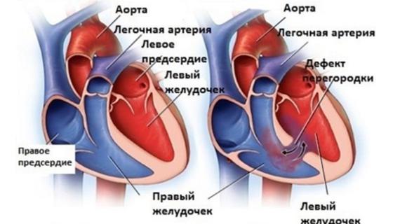 Превью картинка статьи Врожденный порок сердца у детей: причины, симптомы, виды и последствия