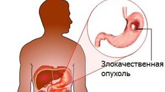 Превью картинка статьи Удаление желудка при раке: сколько можно прожить после операции, отзывы