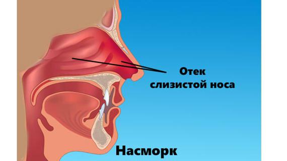 Отек при насморке. Отек слизистой оболочки носа. Отек слизистроц ночэса.