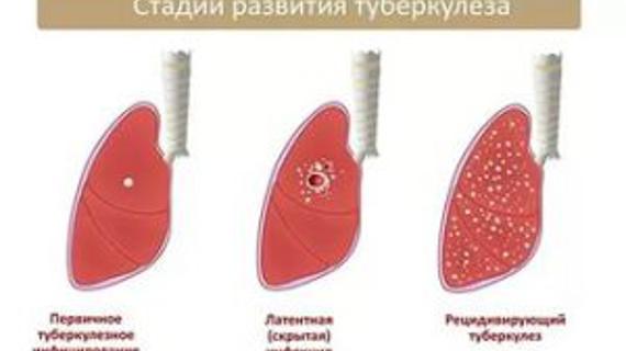 Превью картинка статьи Можно ли работать после туберкулеза в пищевой промышленности