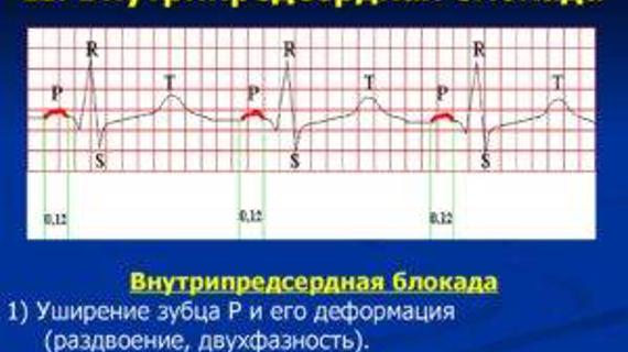 Превью картинка статьи Внутрипредсердная блокада 1 степени что это — Про сосуды