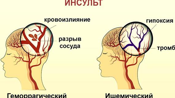 Превью картинка статьи Центры реабилитации после инсульта ростов