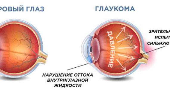 Превью картинка статьи Глазные капли Пролатан: инструкция, отзывы, аналоги, побочные действия