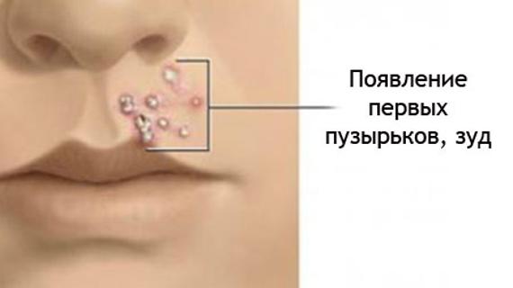 Превью картинка статьи Стрептодермия при беременности