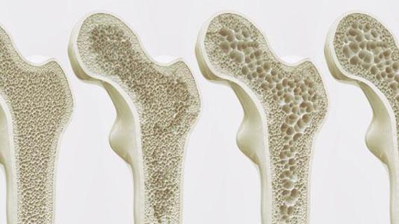 Превью картинка статьи Можно ли делать операцию на позвоночнике если у тебя остеопороз