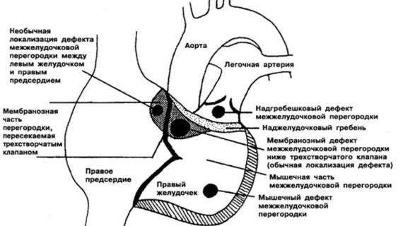 Превью картинка статьи Дефект межжелудочковой перегородки у новорожденного