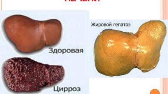 Превью картинка статьи Диффузные изменения печени по типу жирового гепатоза: что это такое, тип стеатоза