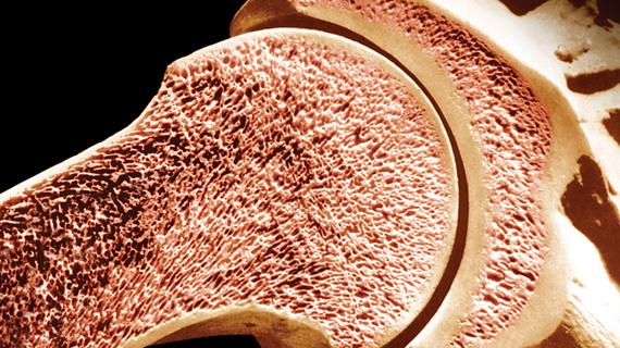 Превью картинка статьи Остеопения — причины, степени, симптомы и лечение