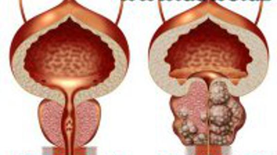 Превью картинка статьи Простата бези аденомаси