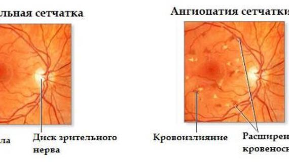 Превью картинка статьи Ангиопатия сетчатки: код по МКБ-10, лечение, типы
