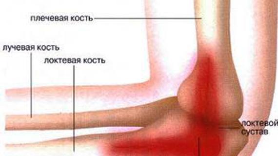 Превью картинка статьи Болит рука в локтевом сгибе — Суставы