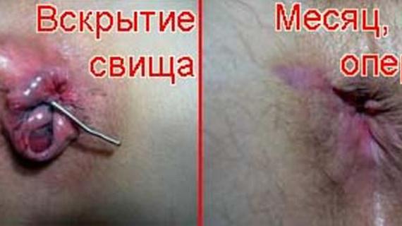Превью картинка статьи Операция парапроктита: фото до и после, подготовка к операции, ход операции, рецидивы и осложнения