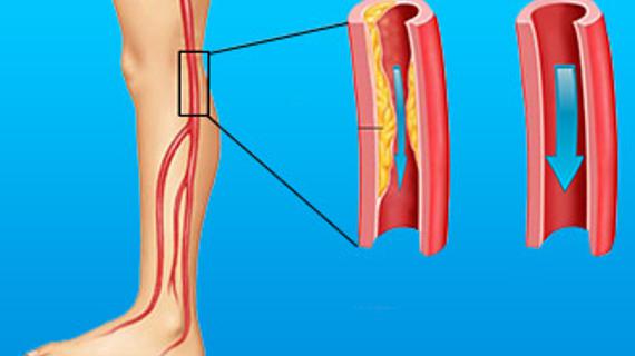 Облитерирующий атеросклероз вен нижних конечностей. Облитерирующий атеросклероз сосудов ног. Атеросклероз артерий конечностей.