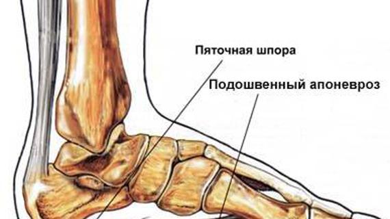Превью картинка статьи Пяточная шпора причины возникновения — Суставы