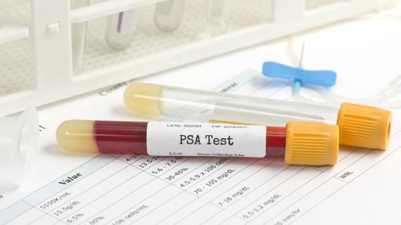 Превью картинка статьи Какой показатель пса может быть при аденоме простаты