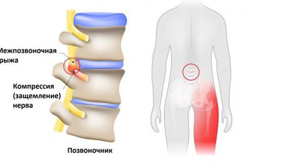 Превью картинка статьи Можно ли купаться в море при ишиасе