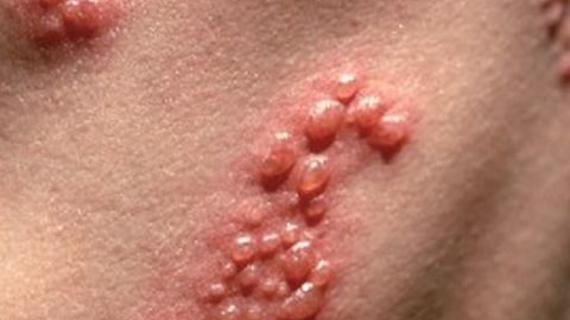 Превью картинка статьи Помогает ли переливание крови от герпеса на