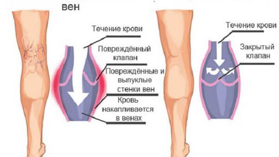 Превью картинка статьи Варикозная болезнь нижних конечностей: код МКБ 10