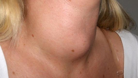 Превью картинка статьи Зоб щитовидной железы – Медицинский портал