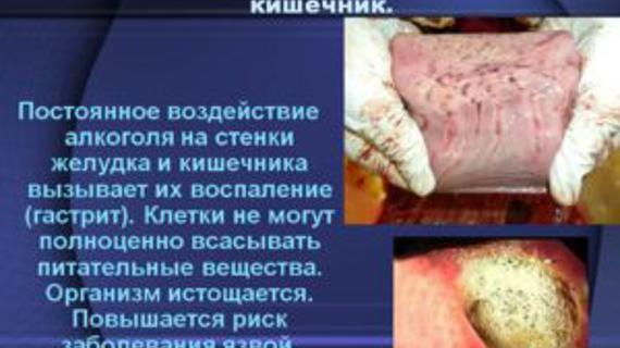 Превью картинка статьи Как пиво влияет на желудок и кишечник