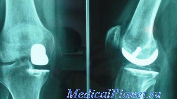 Превью картинка статьи Может ли остеомиелит перерасти в рак