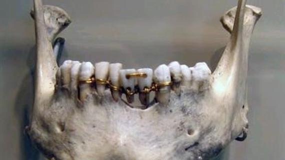 Превью картинка статьи Брекеты когда появились в мире