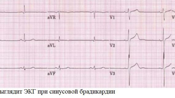 Превью картинка статьи Синусовая брадикардия (брадиаритмия): описание, признаки на ЭКГ и лечение