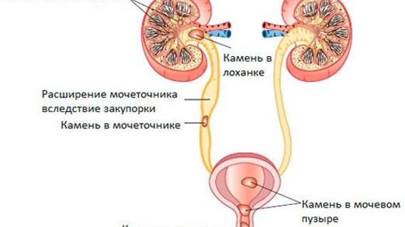 Превью картинка статьи Как удаляют камни в почках через мочеточник