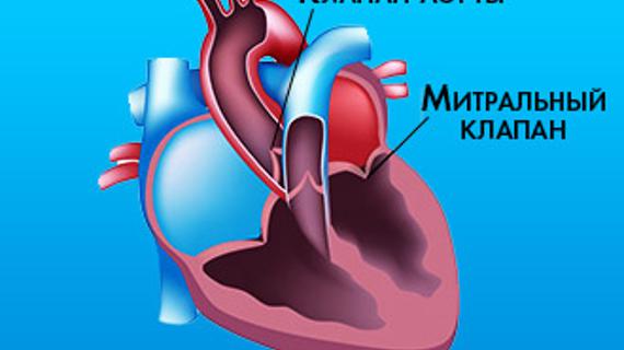 Клапан аорты створки уплотнены. Уплотнение створок аортального и митрального клапанов. Клапаны сердца. Уплотнение стенок аорты что это такое.