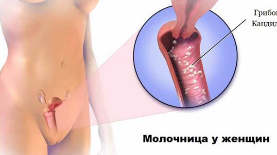 Превью картинка статьи Лечение молочницы в домашних условиях у женщин