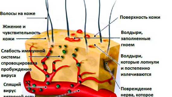 Превью картинка статьи Ветрянка у детей: симптомы, начало, фото, Турецкая ветрянка