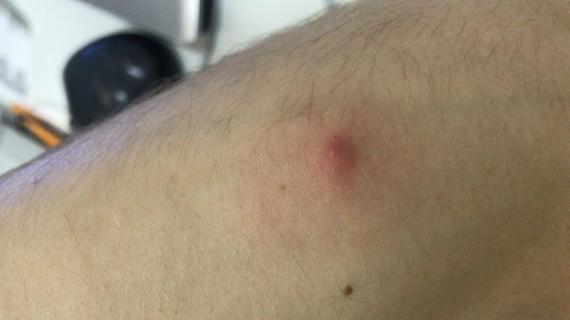 Превью картинка статьи Уплотнение после фурункула: что делать, если на коже осталась шишка и не проходит, как ее убрать?