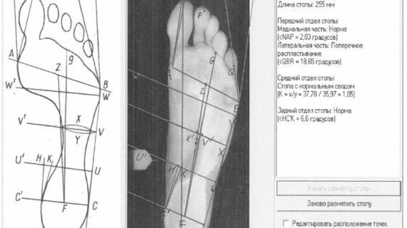 Превью картинка статьи Плантограмма стопы: отпечаток стопы, что такое плантография, плантоскопия стопы в домашних условиях
