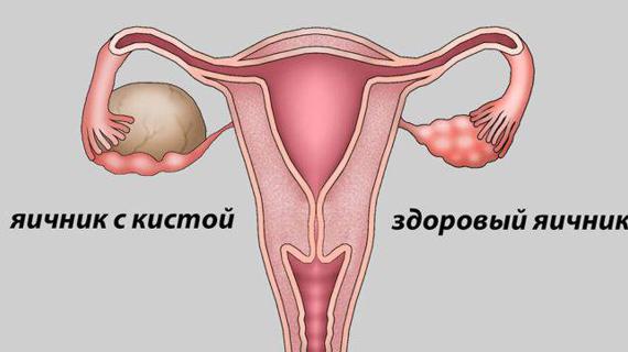 Превью картинка статьи Причины образования кист в организме — Почки