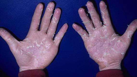 Превью картинка статьи Энтеровирусная инфекция у детей сколько длится карантин