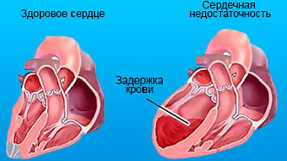 Лево легочная недостаточность. Сердечно-легочная недостаточность. Легочно-сердечная недостаточность. Легочная недостаточность сердца. Острая легочная недостаточность.