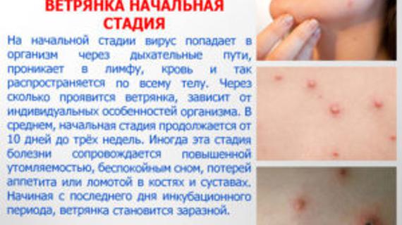 Превью картинка статьи Можно ли заразиться коксаки если болел ветрянкой