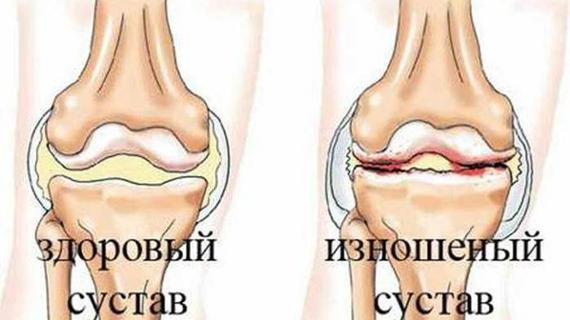 Превью картинка статьи Болят локти что делать — Суставы